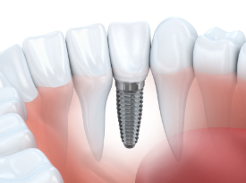 4 Good Reasons to Choose Dental Implants