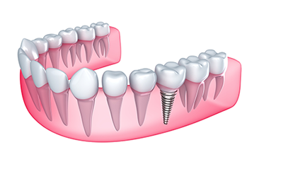 What Is the Importance of Dental Implants?