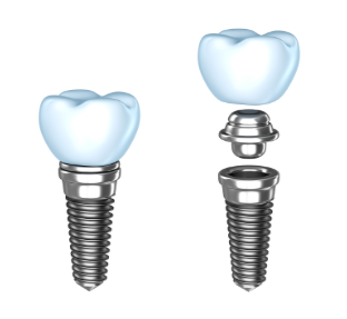 Dental Implants FAQs