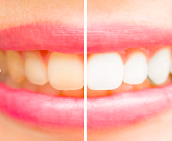 teeth comparison before and after