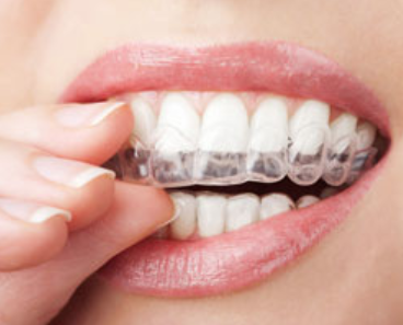 The Advantages Of Invisalign