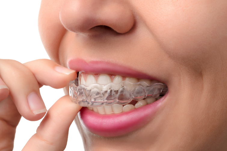 Improve Your Smile With Invisalign