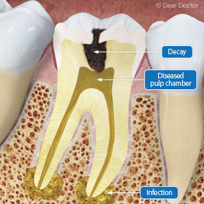 Here’s What you Need to Know about a Root Canal Treatment