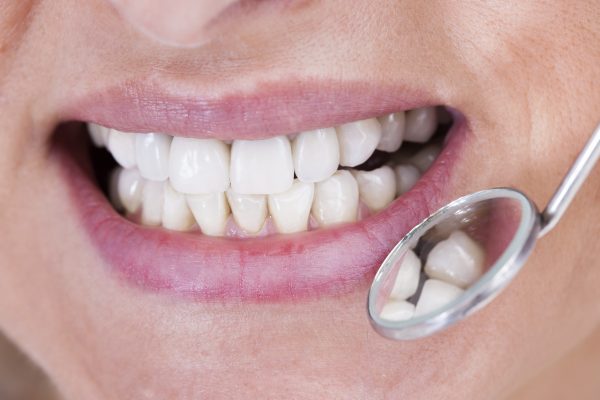 Answering Common Questions About Dental Crowns