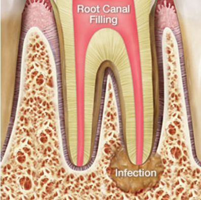 root canal treatment